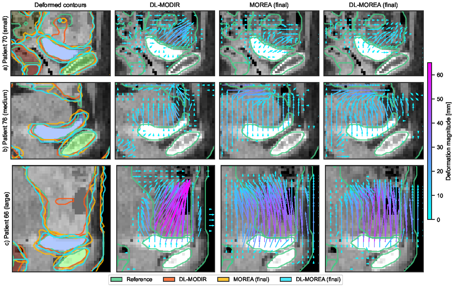 Deformation vectors and contours for three patients, comparing DL-MODIR, MOREA and DL-MOREA